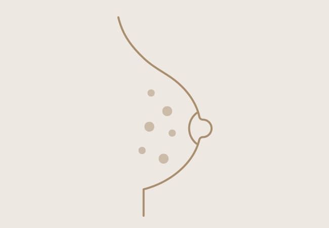 乳腺の石灰化