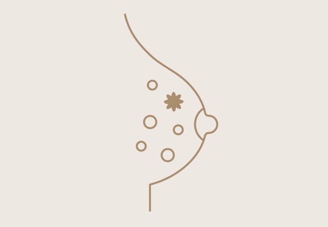 乳がん