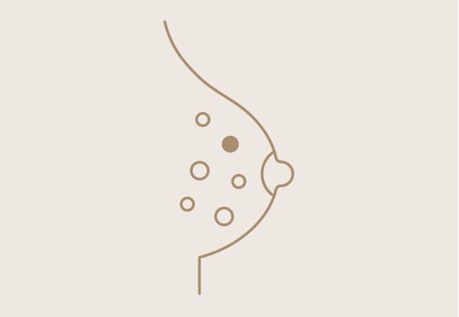 乳腺線維腺腫／葉状腫瘍